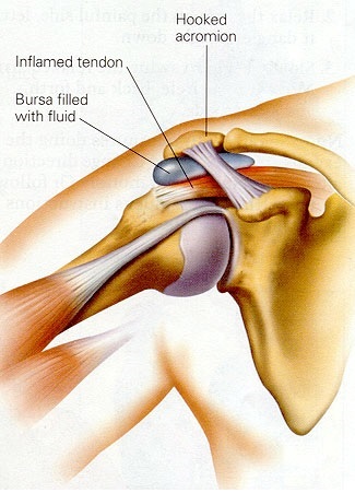 shoulder impingement diagnosis