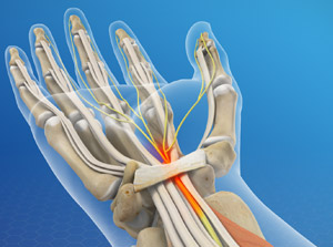 Distal Radius (Wrist) Fractures