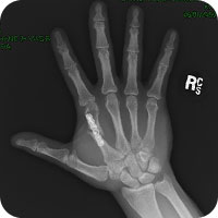 Cmc Arthroplasty