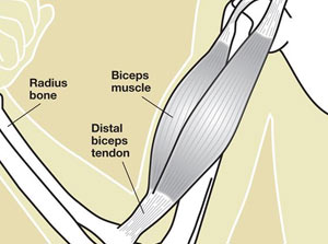 Distal Biceps Tendon Tears