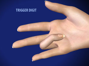 Trigger Finger