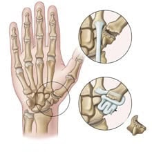 Detailed illustration of a hand's skeletal structure highlighting common joint issues and injuries, suitable for orthopedic diagnosis and patient education.