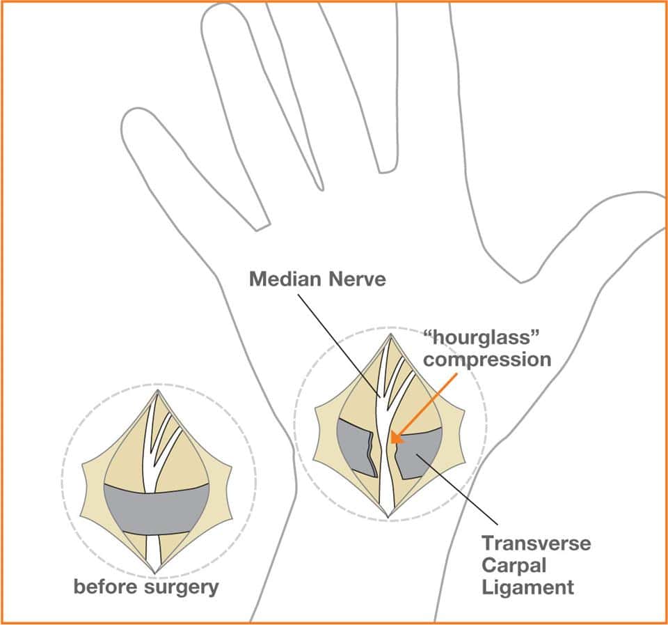 Accessible ALT text for image showing median nerve compression, "hourglass" shape, and transverse carpal ligament before and after surgery, highlighting nerve entrapment and surgical relief.