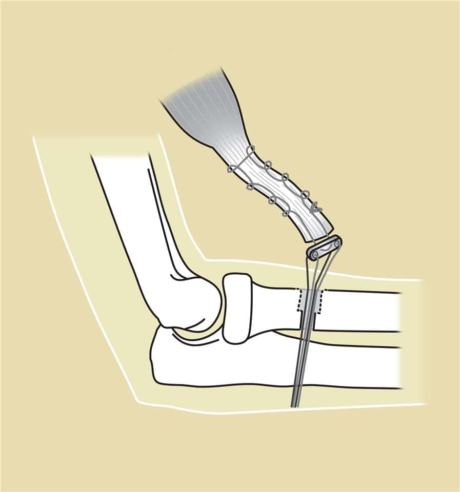 Illustration of a surgical procedure for ankle fracture fixation, showing specialized orthopedic hardware with screws and wires for ankle stabilization.