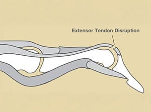 Diagram showing extensor tendon disruption in the finger with damaged tendons and bone, highlighting common injury areas for hand injury analysis.