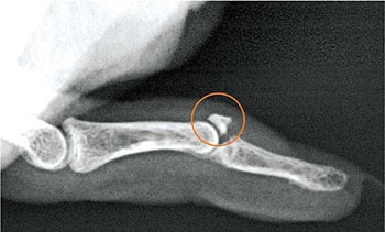 X-ray image showing a broken forearm with a fracture near the wrist joint, highlighting bone injury and medical treatment options for fracture management.