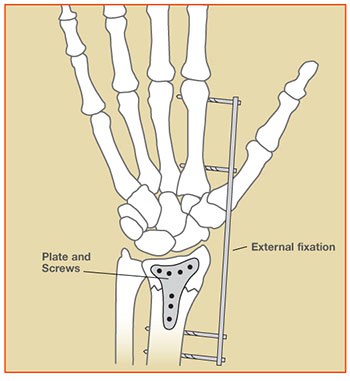 An illustration of a wrist bone with external fixation device, plate, screws, and stabilization apparatus for wrist orthopedic surgery, showcasing surgical hardware for bone fixation.