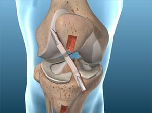 Detailed image of a knee joint undergoing a prosthetic replacement surgery with surgical instruments and prosthetic components.