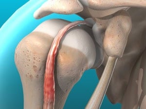 Detailed illustration of a human hip joint, showing the femur, pelvis, and associated structures for educational and medical reference purposes.