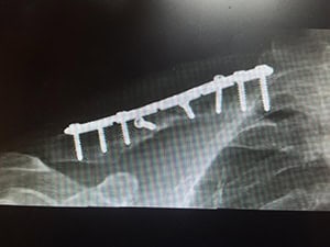 A dental X-ray showing a dental implant with multiple posts surgically placed in the jawbone for tooth replacement.