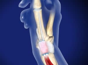 Detailed illustration of a human elbow joint showing a surgical replacement with artificial components for orthopedic medical purposes.