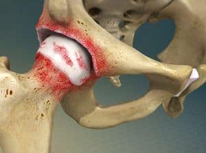 3D model of human pelvic bone with a focus on the acetabulum and surrounding structures, used for medical education and anatomical reference.