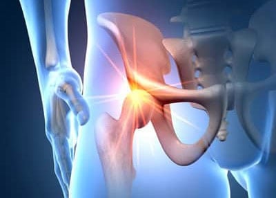 Detailed medical diagram of the hip joint showing bones, cartilage, and surrounding muscles, highlighting joint health and potential issues for better understanding and diagnosis.