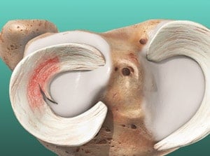 Close-up of a human shoulder with a large, detailed circular surgical wound indicating a shoulder replacement or joint surgery, showcasing the medical procedure involved.