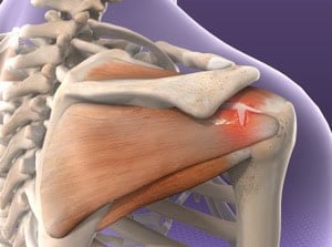 Close-up of shoulder anatomy showing bones, muscles, and tendons, including the rotator cuff muscles and humerus bone, illustrating shoulder joint structure and function for medical education.