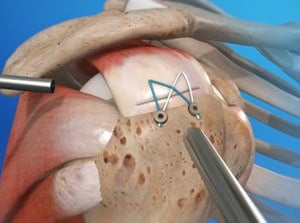 Close-up of dental surgical procedure involving implant placement with precision tools on a patient's jawbone, showcasing advanced dental technology for safe and effective dental implant surgery.