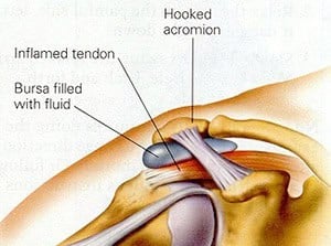 A detailed illustration of shoulder anatomy showing inflamed tendons, bursa filled with fluid, and a hooked acromion, highlighting common causes of shoulder impingement.