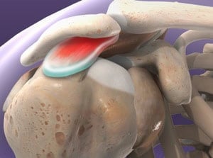 Anatomical illustration of a shoulder joint showing muscles, tendons, and bones for shoulder anatomy and injury explanation.