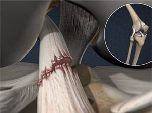 Close-up of injured knee joint showing torn ligament and inflammation, medical illustration highlighting knee injury and anatomy for injury diagnosis and treatment.