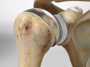 Close-up of a synthetic hip joint prosthesis showing the metal ball and socket components for hip replacement surgery.